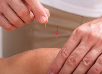Acupuncture